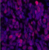 Immunofluorescence analysis of Human lung cancer tissue using Acetyl-Histone H3 (Lys9) Polyclonal Antibody at dilution of 1:200.