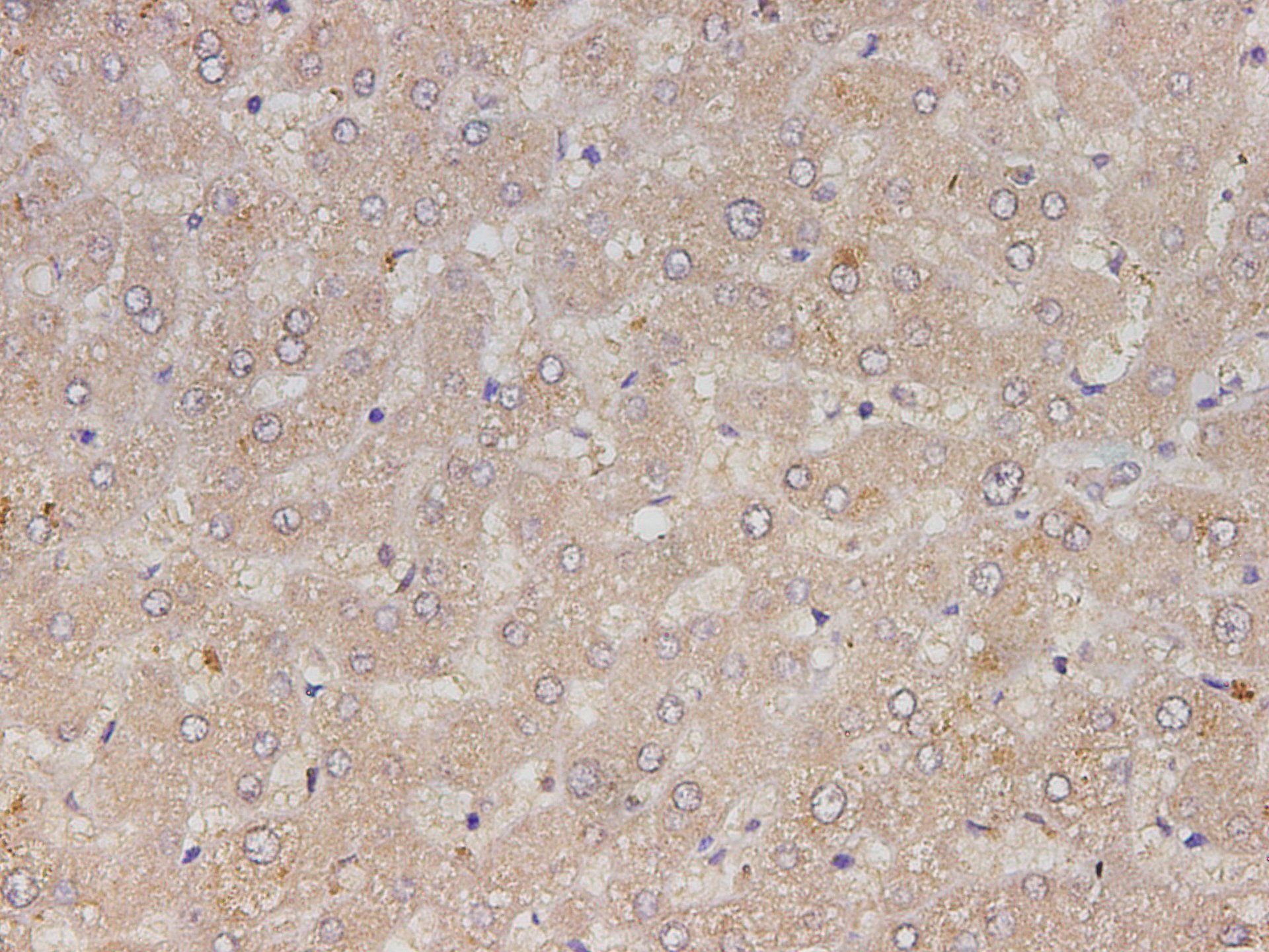 Immunohistochemistry of paraffin-embedded Human liver cancer tissue using RETN Polyclonal Antibody at dilution of 1:150(×400)