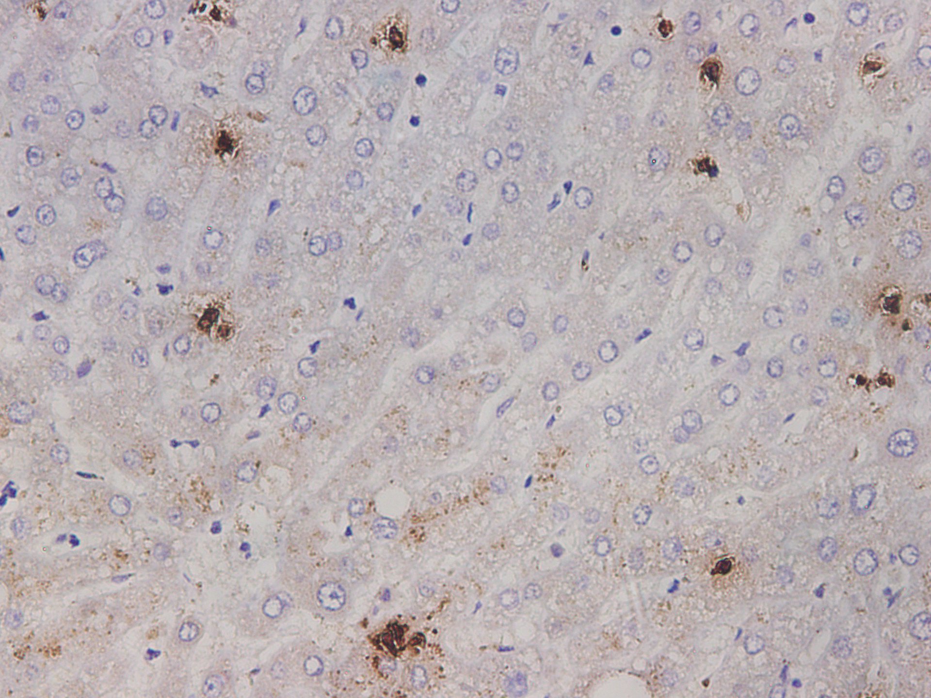 Immunohistochemistry of paraffin-embedded Human liver tissue using IL1A  Polyclonal Antibody at dilution of 1:2000(×400)