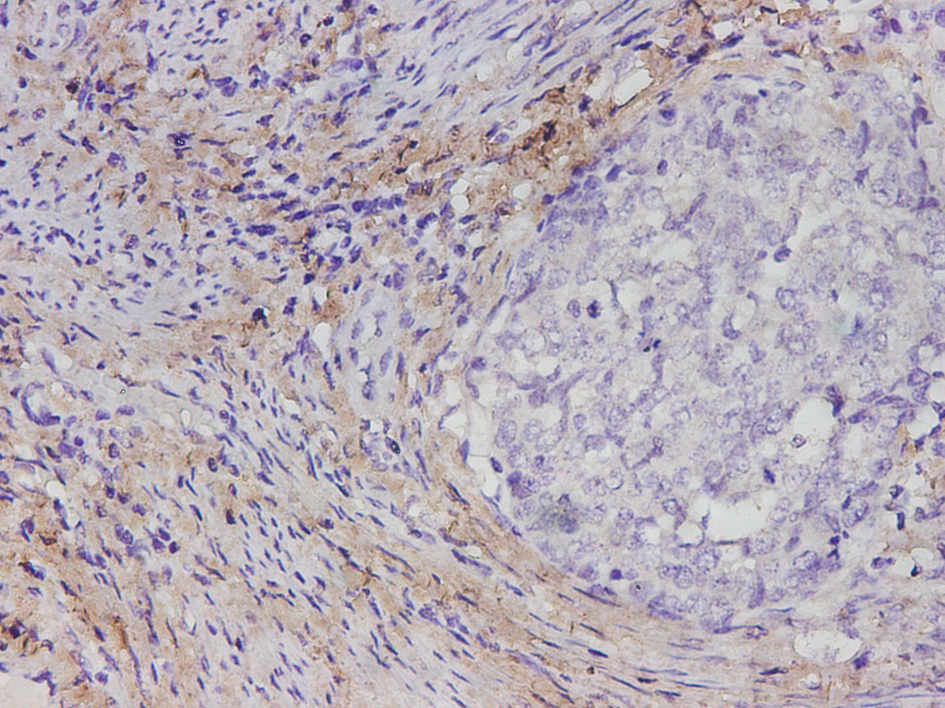 Immunohistochemistry of paraffin-embedded Human cervical cancer tissue using COL1A1 Polyclonal Antibody at dilution of 1:1700(×400)