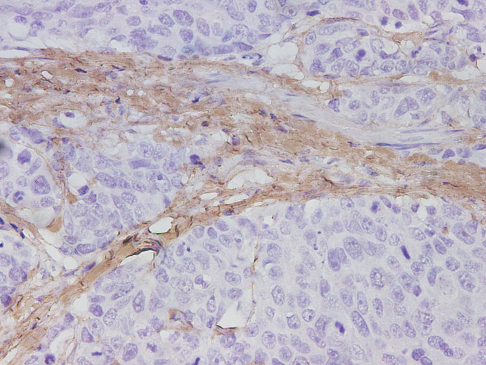 Immunohistochemistry of paraffin-embedded Human stomach cancer tissue using COL1A1 Polyclonal Antibody at dilution of 1:1700(×400)