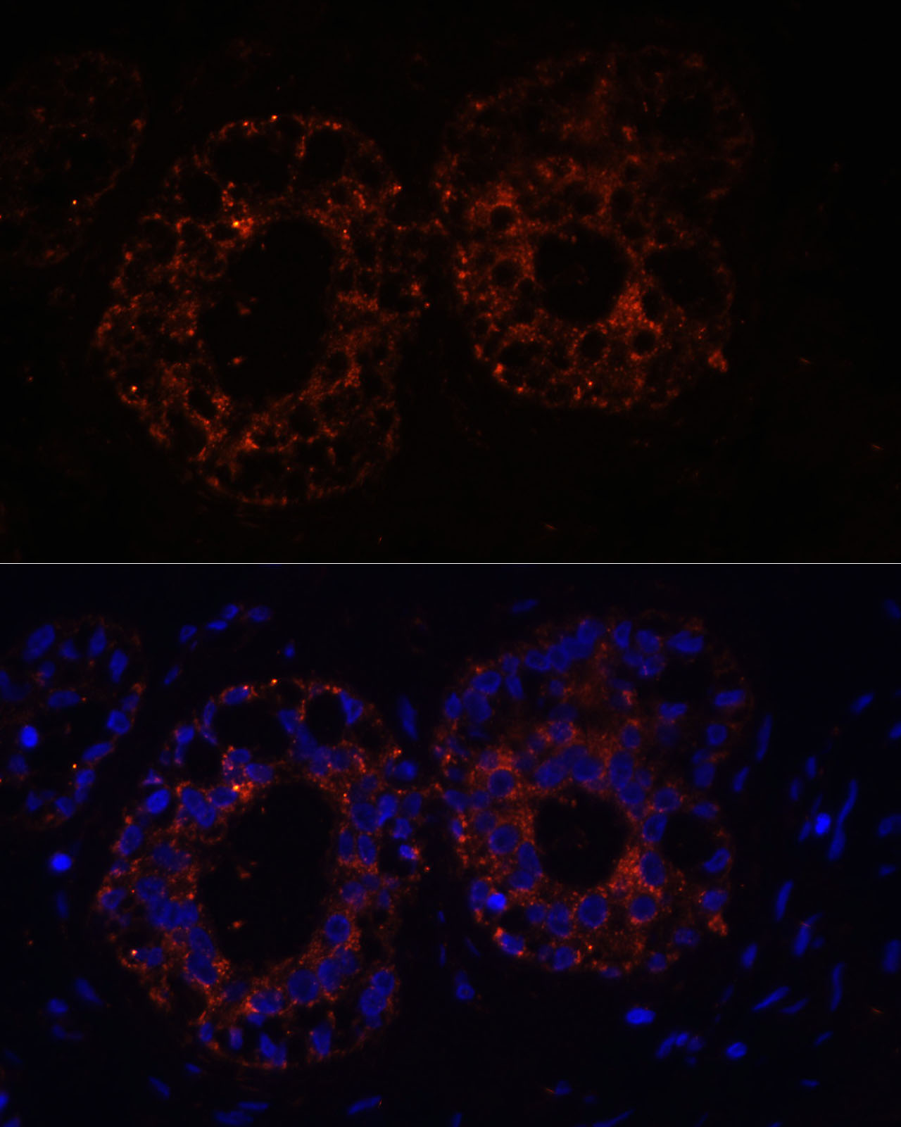 Immunofluorescence analysis of Human mammary cancer cells using TNF-α Polyclonal antibody at dilution of 1:100. Blue: DAPI for nuclear staining.