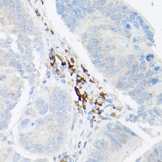 Immunohistochemistry of paraffin-embedded human colon carcinoma using TNF-α Polyclonal Antibody at dilution of 1:20 (40x lens).Perform high pressure antigen retrieval with 10 mM citrate buffer pH 6.0 before commencing with IHC staining protocol.