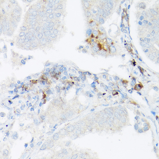 Immunohistochemistry of paraffin-embedded human lung cancer using TNF-α Polyclonal Antibody at dilution of 1:25 (40x lens).Perform high pressure antigen retrieval with 10 mM citrate buffer pH 6.0 before commencing with IHC staining protocol.
