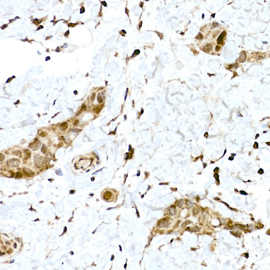 Immunohistochemistry of paraffin-embedded human breast cancer using NRF2 Polyclonal antibody at dilution of 1:100 (40x lens).Perform high pressure antigen retrieval with 10 mM citrate buffer pH 6.0 before commencing with IHC staining protocol.