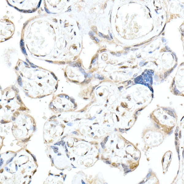 Immunohistochemistry of paraffin-embedded human colon carcinoma using MTAP Polyclonal antibody at dilution of 1:50 (40x lens).Perform high pressure antigen retrieval with 10 mM citrate buffer pH 6.0 before commencing with IHC staining protocol.