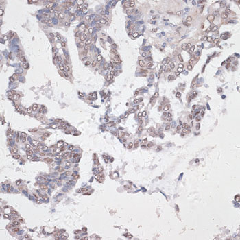 Immunohistochemistry of paraffin-embedded human lung cancer using CREB1 Polyclonal antibody at dilution of 1:100 (40x lens).Perform microwave antigen retrieval with 10 mM PBS buffer pH 7.2 before commencing with IHC staining protocol.