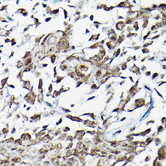 Immunohistochemistry of paraffin-embedded human urothelial carcinoma using Smad2 Polyclonal antibody at dilution of 1:150 (40x lens).Perform high pressure antigen retrieval with 10 mM citrate buffer pH 6.0 before commencing with IHC staining protocol.