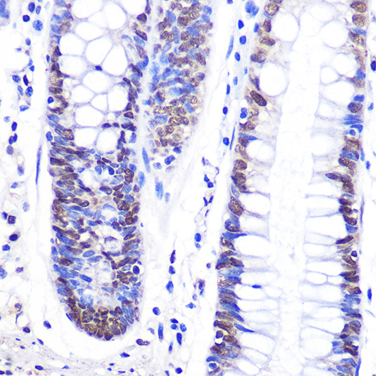 Immunohistochemistry of paraffin-embedded human colon using Snail Polyclonal Antibody at dilution of 1:100 (40x lens).Perform microwave antigen retrieval with 10 mM PBS buffer pH 7.2 before commencing with IHC staining protocol.