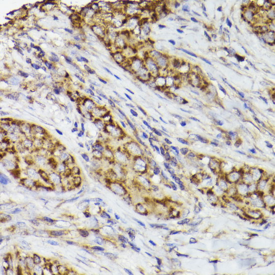 Immunohistochemistry of paraffin-embedded human breast cancer using COX2/PTGS2 Polyclonal antibody at dilution of 1:50 (40x lens).Perform high pressure antigen retrieval with 10 mM citrate buffer pH 6.0 before commencing with IHC staining protocol.