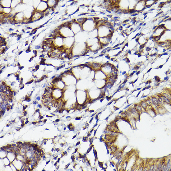 Immunohistochemistry of paraffin-embedded human colon using COX2/PTGS2 Polyclonal antibody at dilution of 1:50 (40x lens).Perform high pressure antigen retrieval with 10 mM citrate buffer pH 6.0 before commencing with IHC staining protocol.