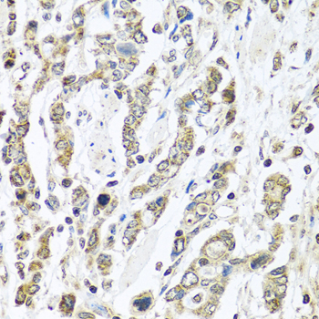 Immunohistochemistry of paraffin-embedded human gastric cancer using IFNL3 Polyclonal antibody at dilution of 1:100 (40x lens).Perform microwave antigen retrieval with 10 mM PBS buffer pH 7.2 before commencing with IHC staining protocol.