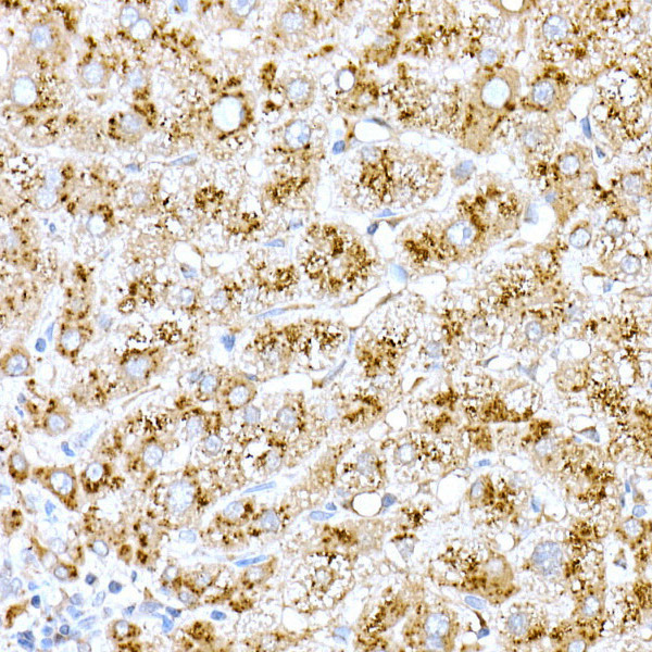 Immunohistochemistry of paraffin-embedded human liver using Cathepsin D Polyclonal antibody at dilution of 1:25 (40x lens).Perform high pressure antigen retrieval with 10 mM citrate buffer pH 6.0 before commencing with IHC staining protocol.