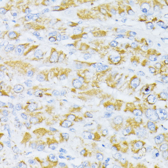 Immunohistochemistry of paraffin-embedded human liver cancer using Cytochrome C Polyclonal antibody at dilution of 1:100 (40x lens).Perform microwave antigen retrieval with 10 mM PBS buffer pH 7.2 before commencing with IHC staining protocol.