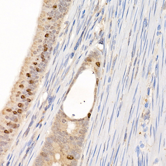 Immunohistochemistry of paraffin-embedded human colon carcinoma using Survivin Polyclonal antibody at dilution of 1:25 (40x lens).Perform high pressure antigen retrieval with 10 mM citrate buffer pH 6.0 before commencing with IHC staining protocol.