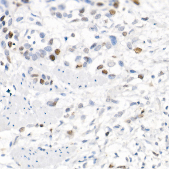 Immunohistochemistry of paraffin-embedded human esophageal cancer using Survivin Polyclonal antibody at dilution of 1:25 (40x lens).Perform high pressure antigen retrieval with 10 mM citrate buffer pH 6.0 before commencing with IHC staining protocol.