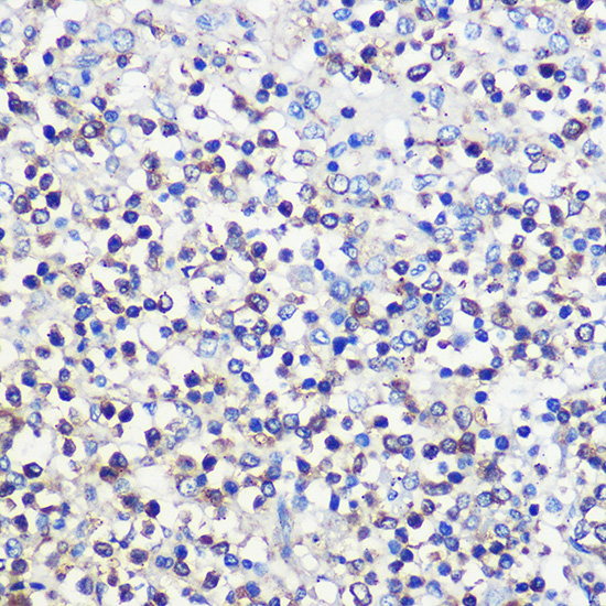 Immunohistochemistry of paraffin-embedded human spleen using CD80 Polyclonal antibody at dilution of 1:100 (40x lens).Perform high pressure antigen retrieval with 10 mM citrate buffer pH 6.0 before commencing with IHC staining protocol.