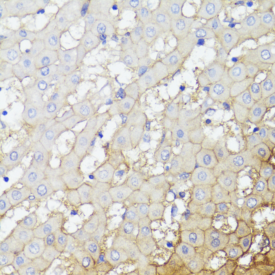 Immunohistochemistry of paraffin-embedded Human liver cancer using CD276/B7-H3 Polyclonal antibody at dilution of 1:100 (40x lens).Perform microwave antigen retrieval with 10 mM PBS buffer pH 7.2 before commencing with IHC staining protocol.