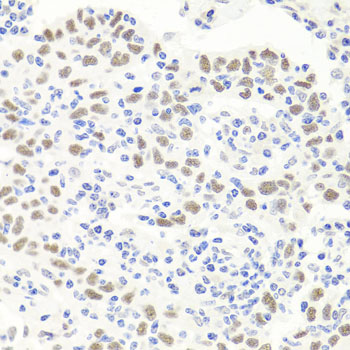 Immunohistochemistry of paraffin-embedded human esophageal cancer using EXO1 Polyclonal Antibody at dilution of 1:100 (40x lens).Perform microwave antigen retrieval with 10 mM PBS buffer pH 7.2 before commencing with IHC staining protocol.