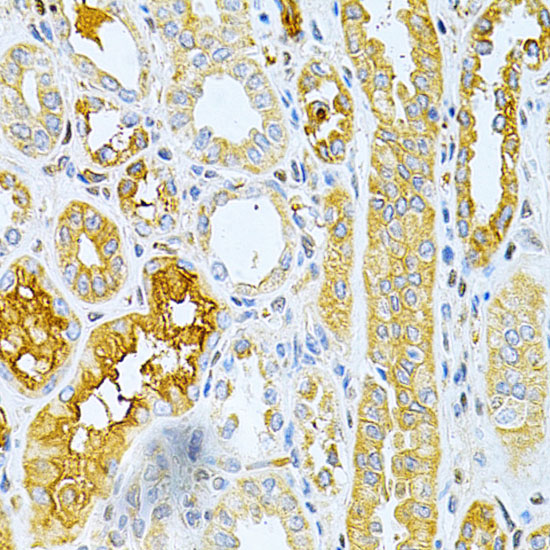 Immunohistochemistry of paraffin-embedded human kidney cancer using TNFRSF11B Polyclonal antibody at dilution of 1:200 (40x lens).Perform microwave antigen retrieval with 10 mM PBS buffer pH 7.2 before commencing with IHC staining protocol.