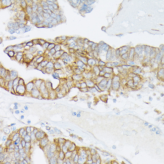 Immunohistochemistry of paraffin-embedded human oophoroma using [KO Validated] MRP4/ABCC4 Polyclonal antibody at dilution of 1:50 (40x lens).Perform high pressure antigen retrieval with 10 mM citrate buffer pH 6.0 before commencing with IHC staining protocol.