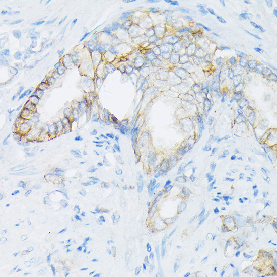 Immunohistochemistry of paraffin-embedded human prostate cancer using [KO Validated] MRP4/ABCC4 Polyclonal antibody at dilution of 1:50 (40x lens).Perform high pressure antigen retrieval with 10 mM citrate buffer pH 6.0 before commencing with IHC staining