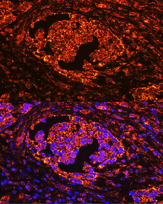 Immunofluorescence analysis of human lung cancer using ACP5 Polyclonal antibody at dilution of 1:100 (40x lens). Blue: DAPI for nuclear staining.