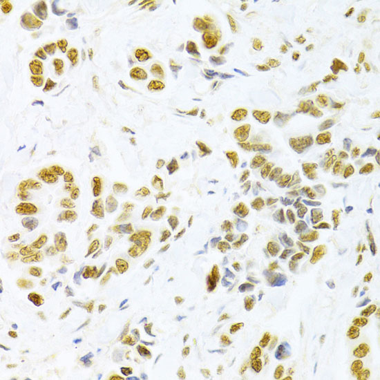 Immunohistochemistry of paraffin-embedded human breast cancer using HMGB1 Polyclonal antibody at dilution of 1:100 (40x lens).Perform microwave antigen retrieval with 10 mM PBS buffer pH 7.2 before commencing with IHC staining protocol.