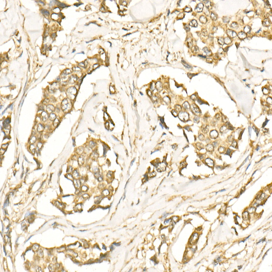 Immunohistochemistry of paraffin-embedded Human breast cancer using LC3B Polyclonal Antibody at dilution of 1:250 (20x lens).Perform high pressure antigen retrieval with 10 mM citrate buffer pH 6.0 before commencing with IHC staining protocol.