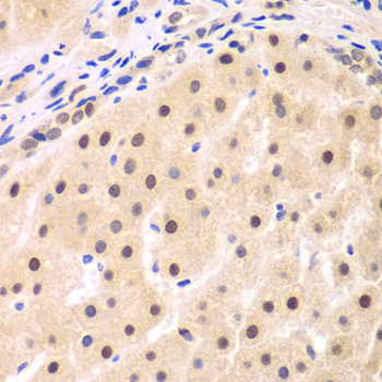 Immunohistochemistry of paraffin-embedded human liver cancer using NFKBIB Polyclonal antibody at dilution of 1:200 (40x lens).Perform microwave antigen retrieval with 10 mM PBS buffer pH 7.2 before commencing with IHC staining protocol.