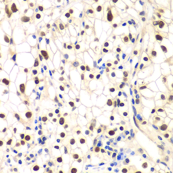 Immunohistochemistry of paraffin-embedded human kidney cancer using NFKBIB Polyclonal antibody at dilution of 1:200 (40x lens).Perform microwave antigen retrieval with 10 mM PBS buffer pH 7.2 before commencing with IHC staining protocol.