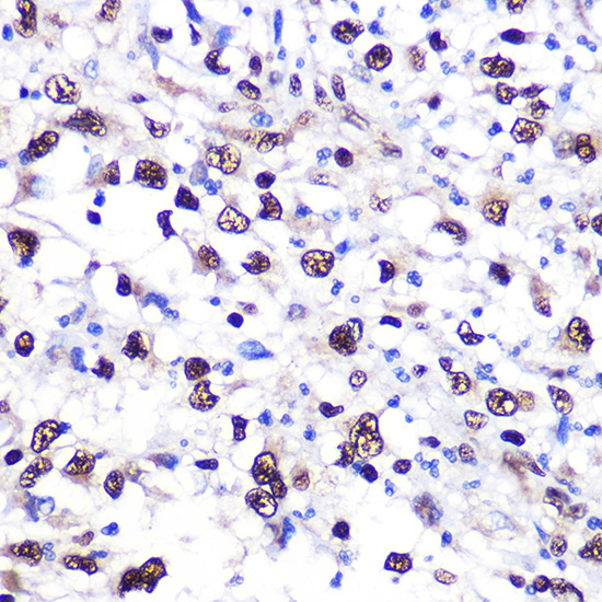 Immunohistochemistry of paraffin-embedded human liver cancer using NCL Polyclonal Antibody at dilution of 1:100 (40x lens).Perform microwave antigen retrieval with 10 mM PBS buffer pH 7.2 before commencing with IHC staining protocol.