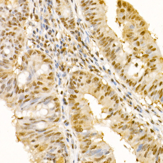 Immunohistochemistry of paraffin-embedded human colon carcinoma using SS18 Polyclonal Antibody at dilution of 1:100 (40x lens).Perform high pressure antigen retrieval with 10 mM citrate buffer pH 6.0 before commencing with IHC staining protocol.