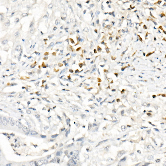 Immunohistochemistry of paraffin-embedded Human colon carcinoma using CCL2/MCP-1 Polyclonal antibody at dilution of 1:50 (40x lens).Perform high pressure antigen retrieval with 10 mM citrate buffer pH 6.0 before commencing with IHC staining protocol.