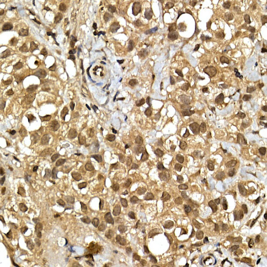 Immunohistochemistry of paraffin-embedded human breast cancer using SQSTM1/p62 Polyclonal Antibody at dilution of 1:100 (40x lens).Perform high pressure antigen retrieval with 10 mM citrate buffer pH 6.0 before commencing with IHC staining protocol.