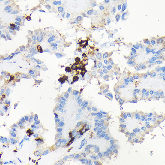 Immunohistochemistry of paraffin-embedded human thyroid cancer using CORO1A Polyclonal antibody at dilution of 1:100 (40x lens).Perform high pressure antigen retrieval with 10 mM citrate buffer pH 6.0 before commencing with IHC staining protocol.