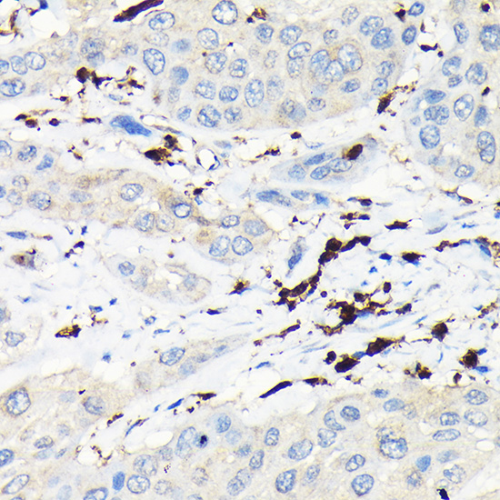 Immunohistochemistry of paraffin-embedded human esophageal cancer using CORO1A Polyclonal antibody at dilution of 1:100 (40x lens).Perform high pressure antigen retrieval with 10 mM citrate buffer pH 6.0 before commencing with IHC staining protocol.