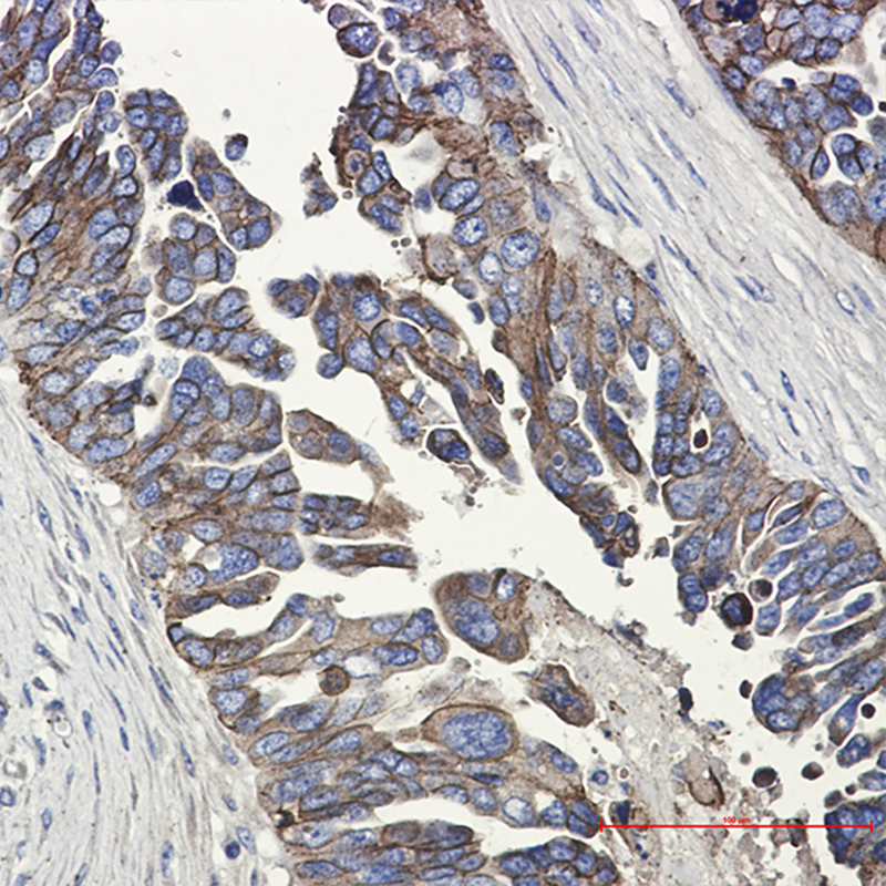 Immunohistochemistry of E Cadherin in paraffin-embedded Human Cholangiocarcinoma using E Cadherin Rabbit mAb at dilution 1:50