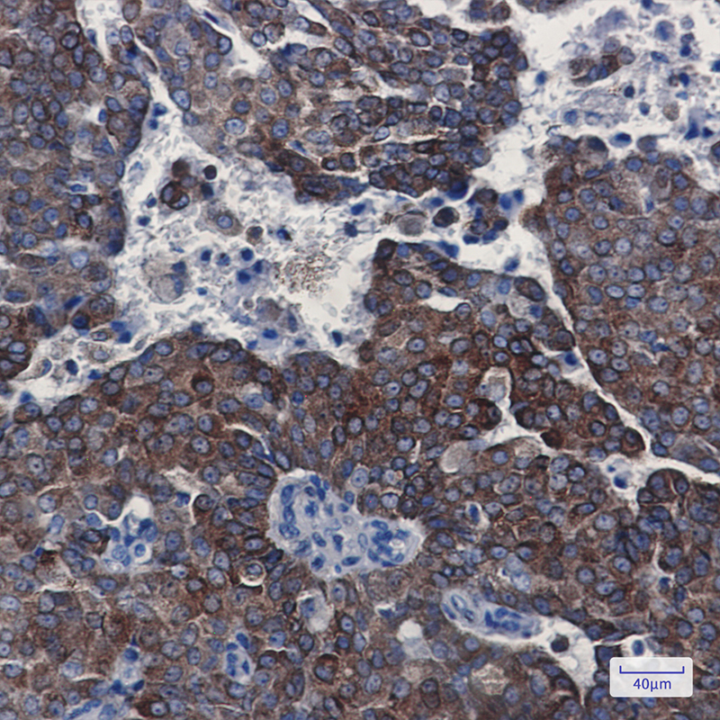 Immunohistochemistry of Bcl-2 in paraffin-embedded Human breast cancer tissue using Bcl-2 Rabbit mAb at dilution 1:100