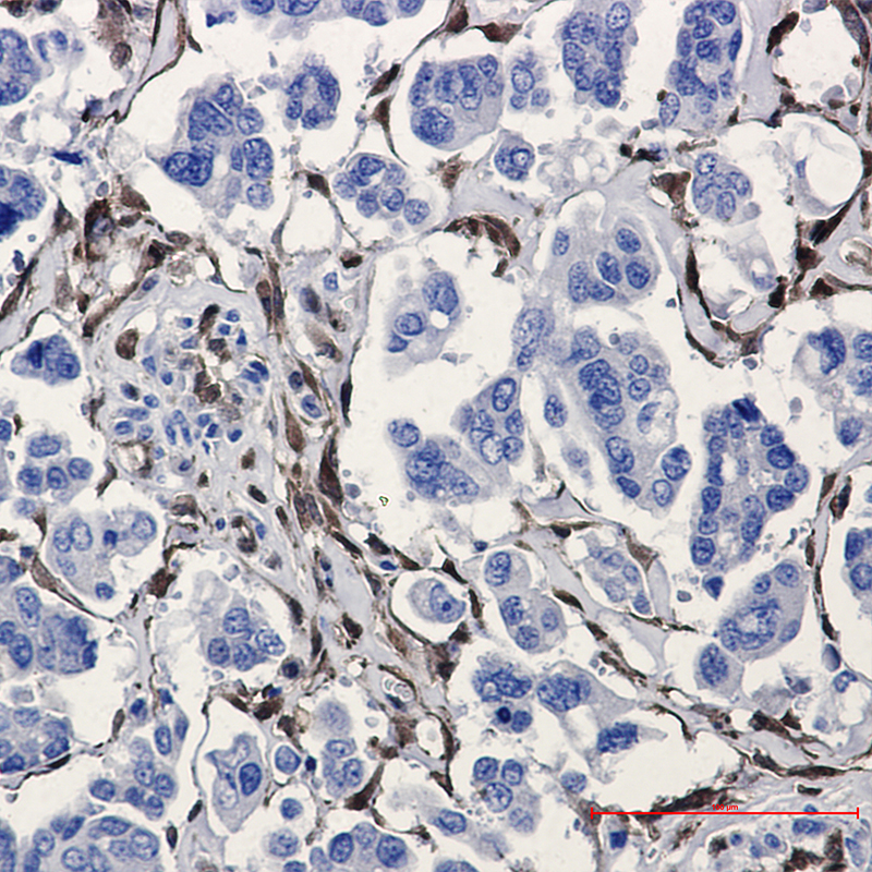 Immunohistochemistry of ALDH1A1 in paraffin-embedded Human Cholangiocarcinoma using ALDH1A1 Rabbit mAb at dilution 1:20