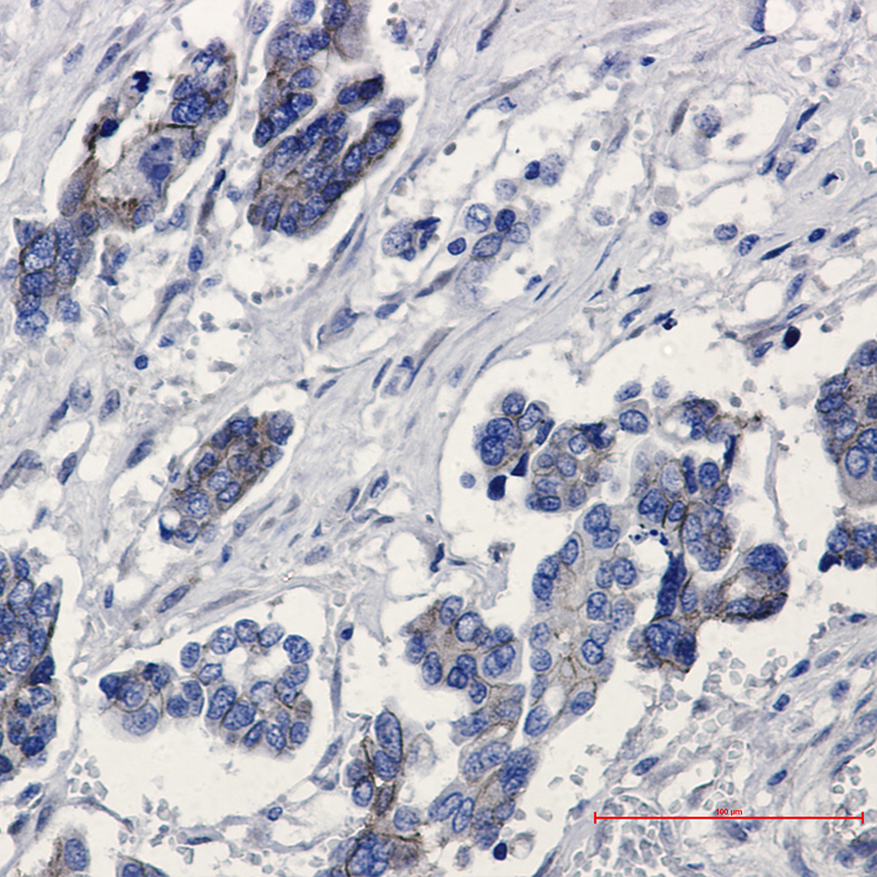 Immunohistochemistry of beta Catenin in paraffin-embedded Human Cholangiocarcinoma using beta Catenin Rabbit mAb at dilution 1:50