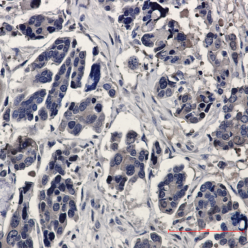 Immunohistochemistry of ERK2 in paraffin-embedded Human Cholangiocarcinoma using ERK2 Rabbit mAb at dilution 1:20