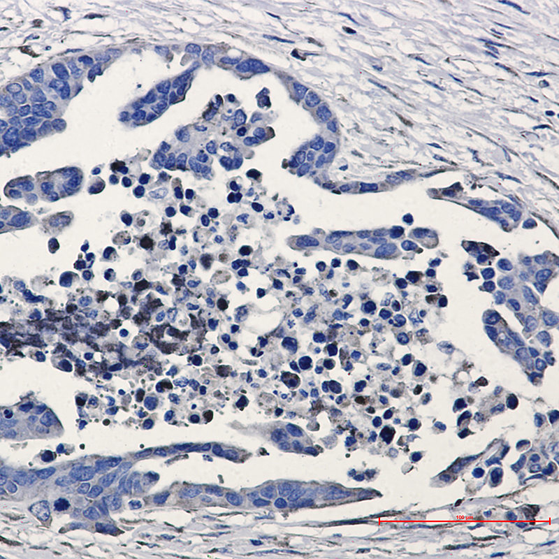 Immunohistochemistry of GSK3 beta in paraffin-embedded Human Cholangiocarcinoma using GSK3 beta Rabbit mAb at dilution 1:20