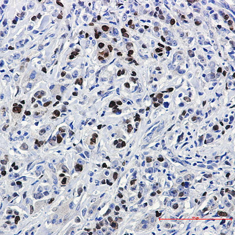 Immunohistochemistry of SOX9 in paraffin-embedded Human breast cancer tissue using SOX9 Rabbit mAb at dilution 1:20