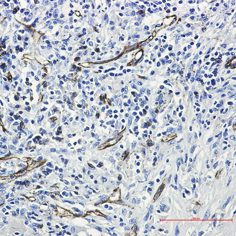 Immunohistochemistry of CD31 in paraffin-embedded Human lung cancer tissue using CD31 Rabbit mAb at dilution 1/50