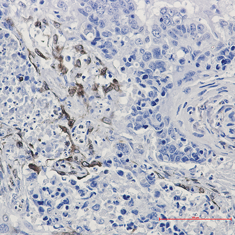 Immunohistochemistry of COX2 in paraffin-embedded Human lung cancer tissue using COX2 Rabbit mAb at dilution 1:50