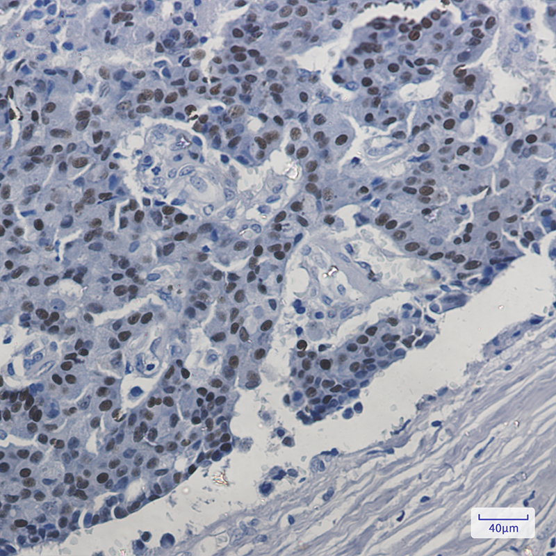 Immunohistochemistry of Estrogen Receptor alpha in paraffin-embedded Human breast cancer tissue using Estrogen Receptor alpha Rabbit mAb at dilution 1:50