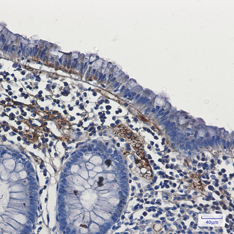 Immunohistochemistry of FAK in paraffin-embedded Human colon cancer tissue using FAK Rabbit mAb at dilution 1:50