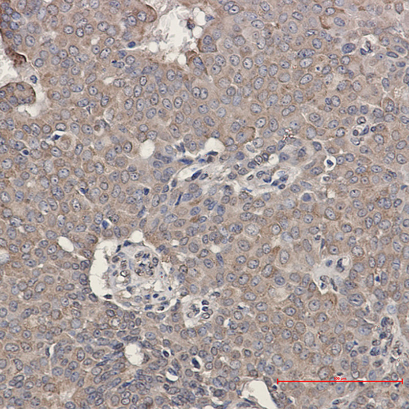 Immunohistochemistry of GRP78 BiP in paraffin-embedded Human breast cancer tissue using GRP78 BiP Rabbit mAb at dilution 1:50