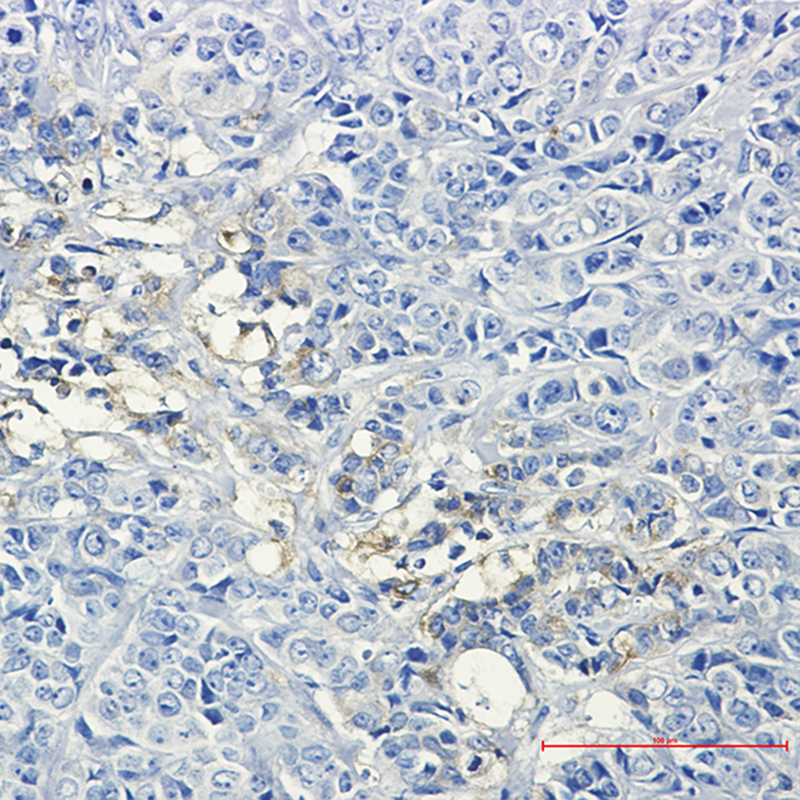 Immunohistochemistry of Hexokinase II in paraffin-embedded Human breast cancer tissue using Hexokinase II Rabbit mAb at dilution 1/50